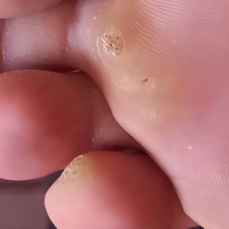 Ayak siğili nasıl görünür