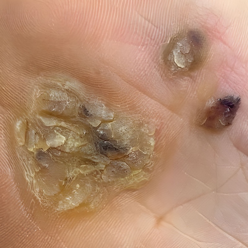 Ayak siğili resimleri